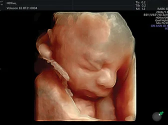 Glossy Image Fetal face